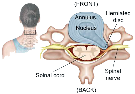 Techlamed Discolux Cervicale