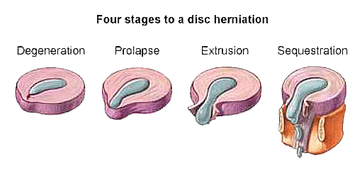 Techlamed Discolux Cervicale