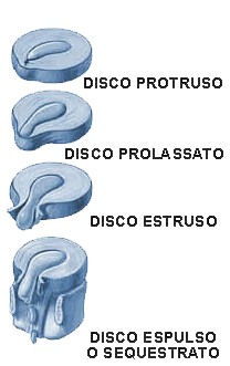 Techlamed Discolux Cervicale