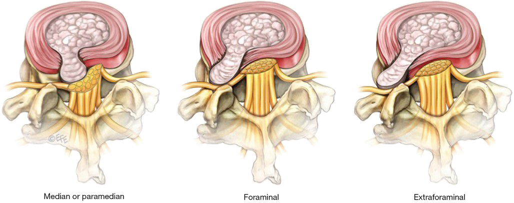 Techlamed Discolux Cervicale