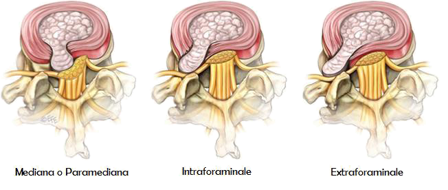 Techlamed Discolux Cervicale