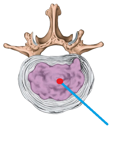 Techlamed Discolux Cervicale