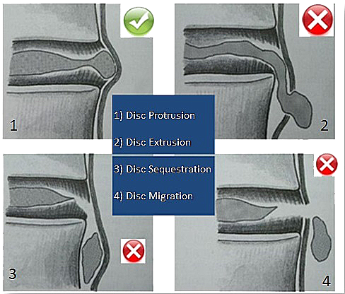 Techlamed Discolux Cervicale
