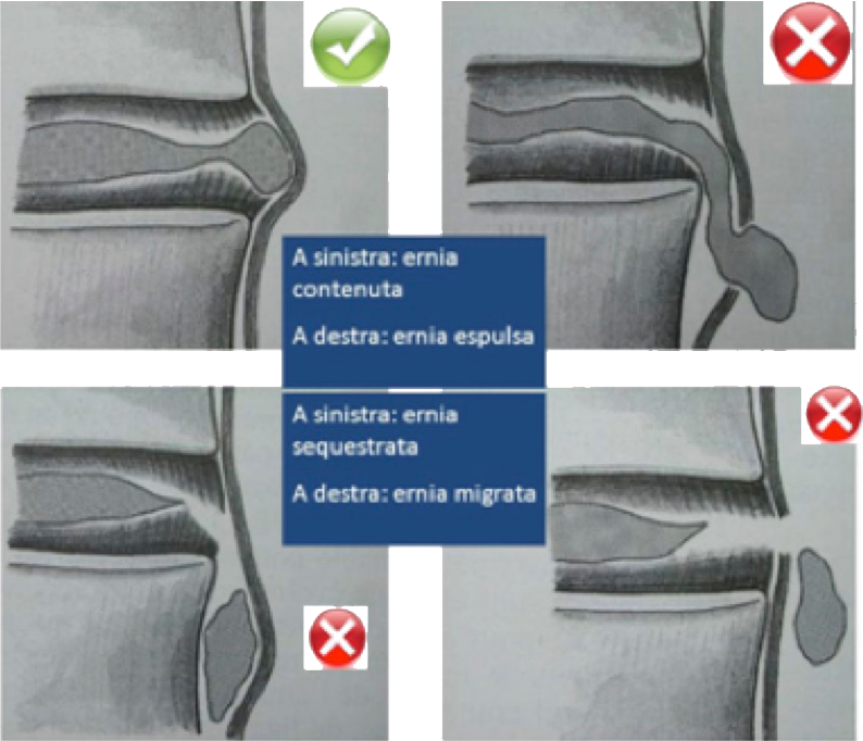 Techlamed Discolux Cervicale