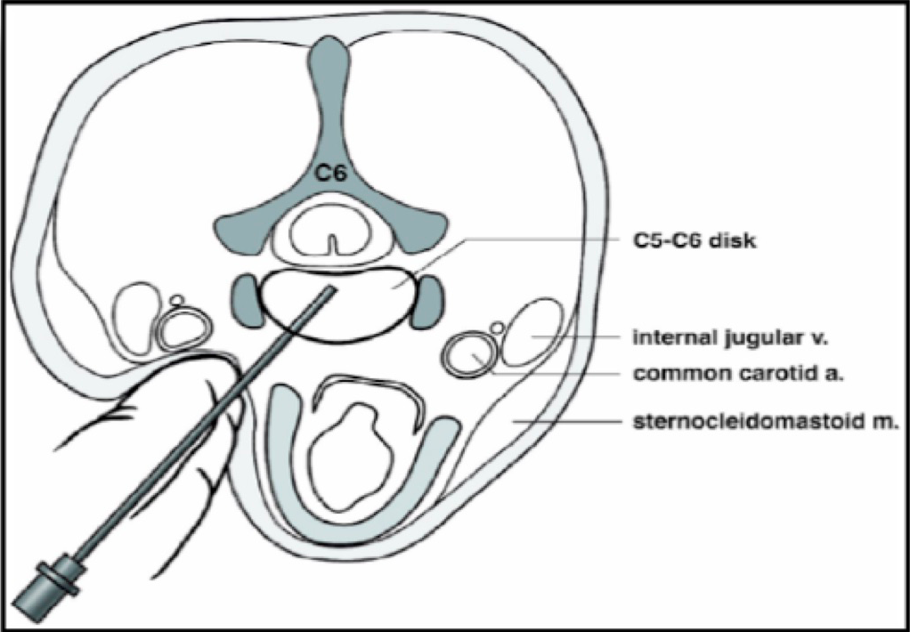 Techlamed Discolux Cervicale