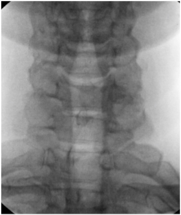 Techlamed Discolux Cervicale