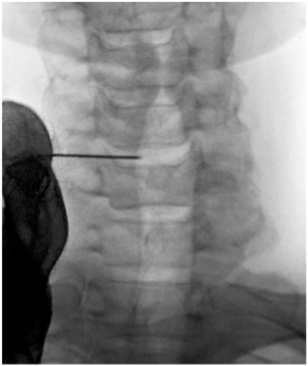Techlamed Discolux Cervicale