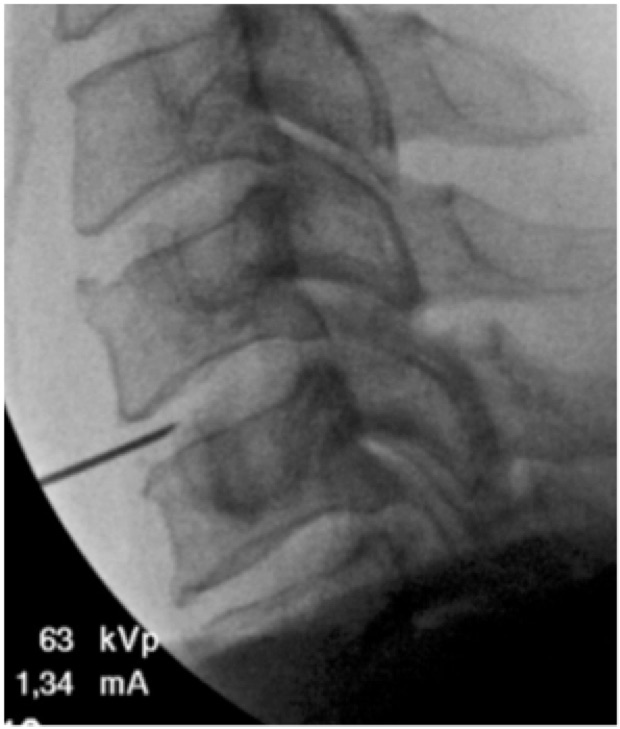 Techlamed Discolux Cervicale